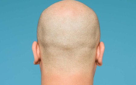 The study shows that bald men are at a higher risk of developing severe COVID
