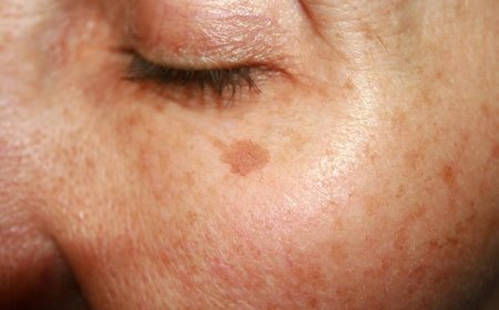 12 incredible home remedies for removing skin marks