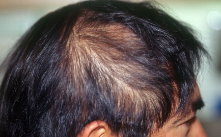 Mental disorders and hair loss - a non-obvious but real link