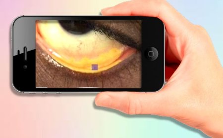 Smartphones can already detect anemia! Just take a picture