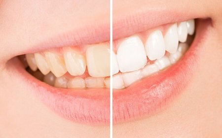 The causes of discolored teeth