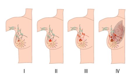 Understanding Stage 1 Breast Cancer: Symptoms and Early Detection