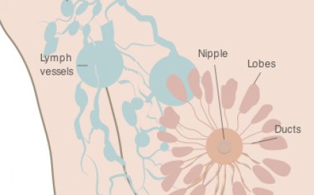 Understanding Stage 0 Breast Cancer: Symptoms, Diagnosis, and Treatment
