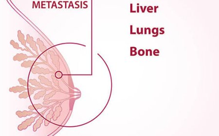 Understanding Early-Stage Breast Cancer