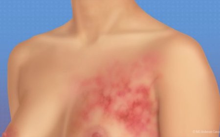 How to Check If You Have Breast Cancer